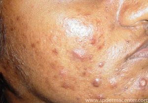 Acne-Before